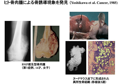 ヒト骨肉腫による骨誘導現象を発見
